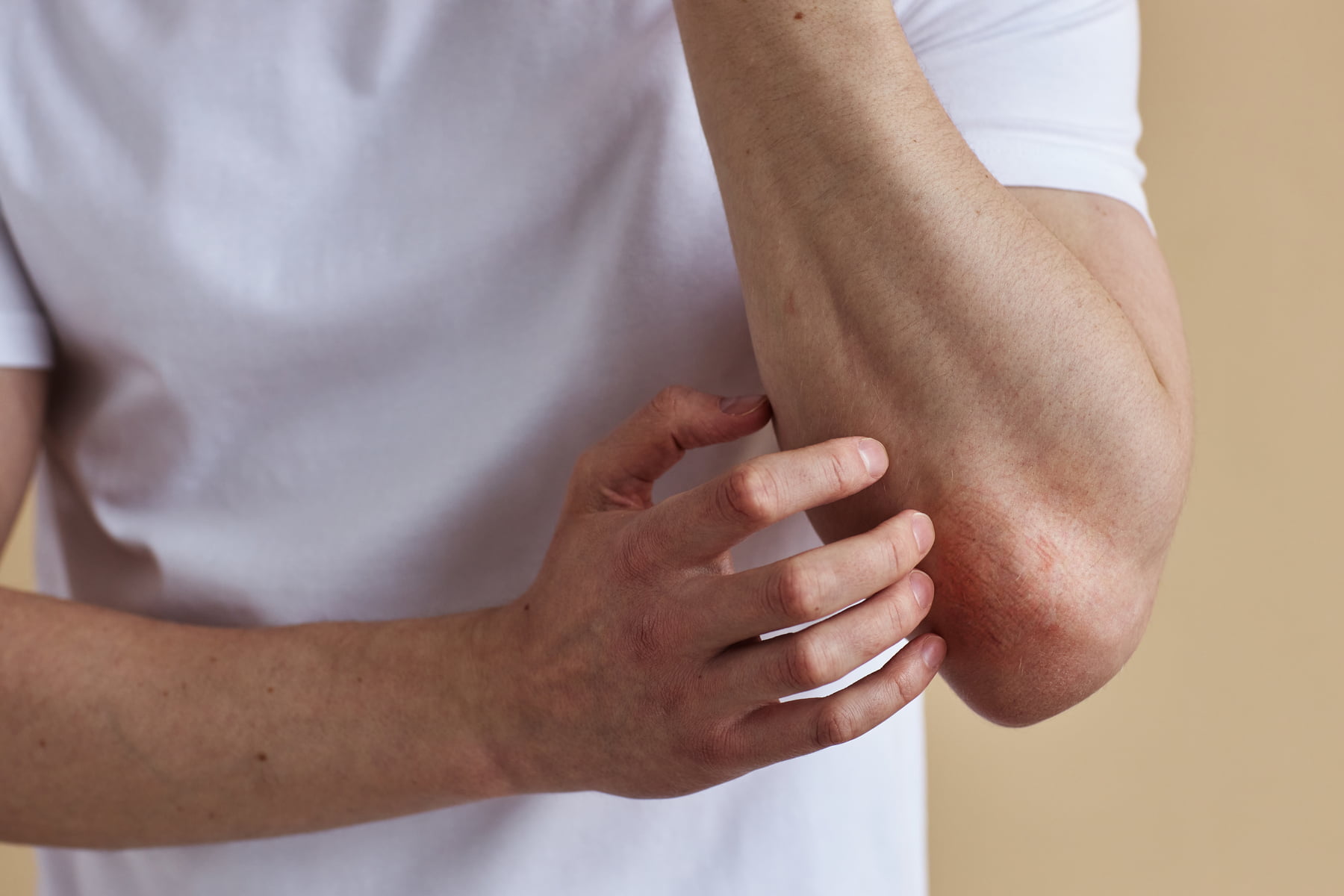 Close up of man scratching elbow rash or skin condition